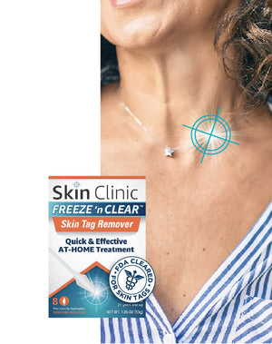 How to Remove Skin Tags with Freeze 'n Clear