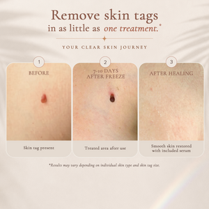 Premium Cryogenic Skin Tag Removal Kit with Post Treatment Serum - FDA-Cleared, Safe, Painless and Effective - Includes 12 Applications and One-Handed Skin Guard